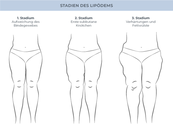 Stadien Lipödem, Dr. Fiorella De Nitto, Gefäßchirurgie München